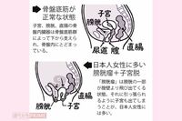 夕方になると股間に違和感、股の間からピンポン玉のようなものが!女性の10人に1人、閉経後に急増する《子…